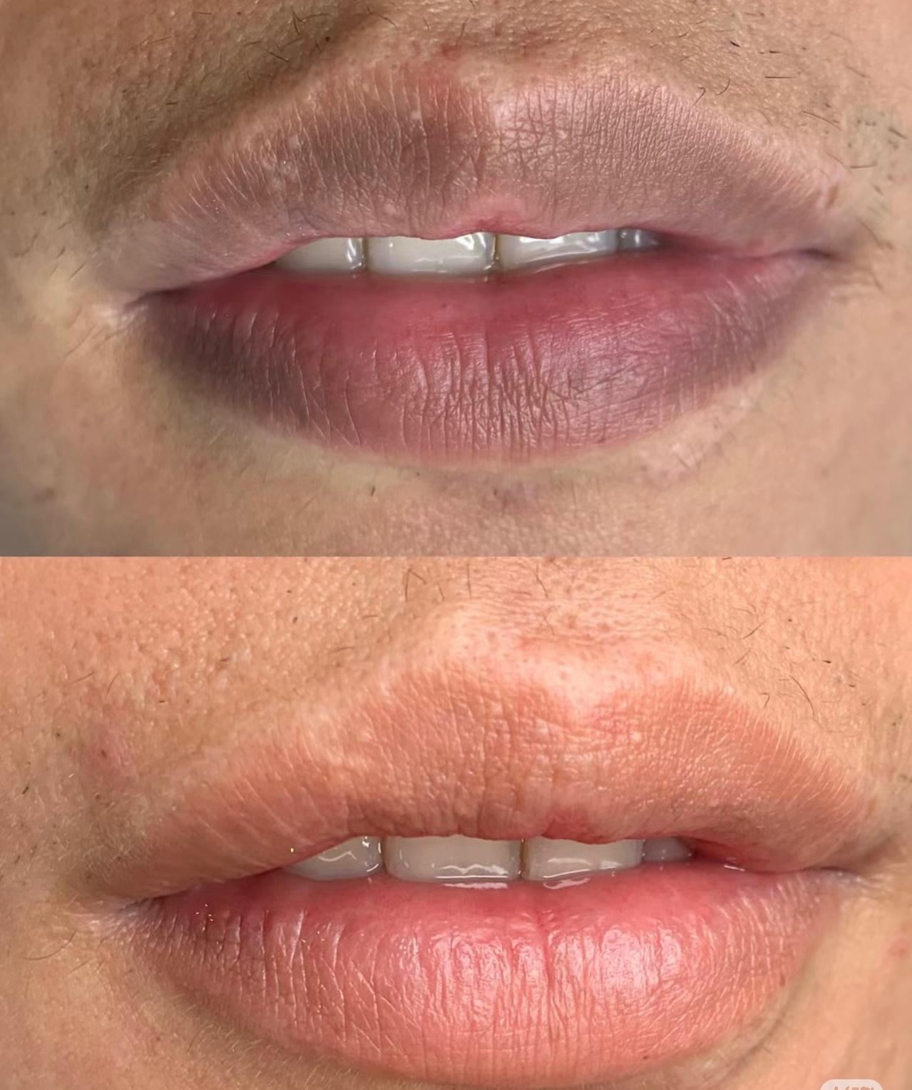 Lip enhancement before and after