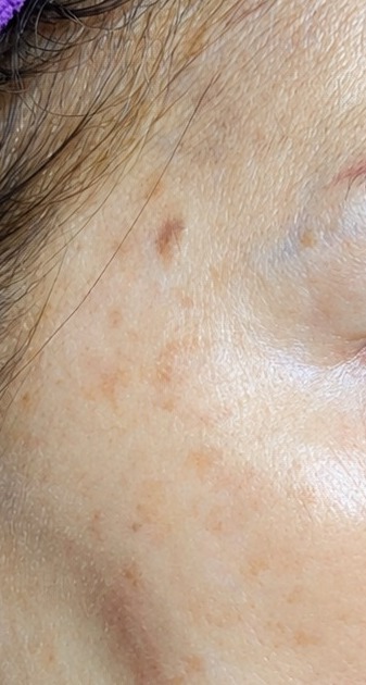 CAK Stem Cell Treatment at Revitalized Beauty